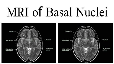 Basal Ganglia Anatomy Mri