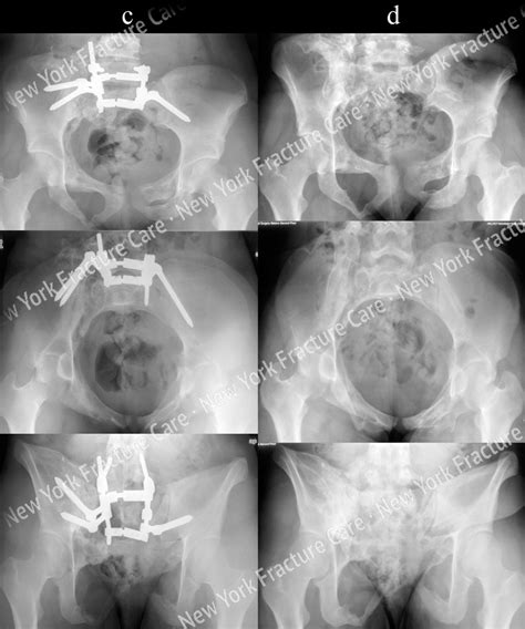 Pelvic fractures - New York Fracture Care