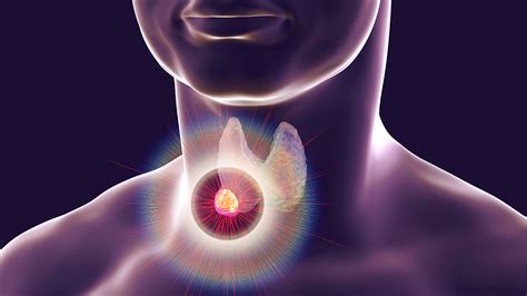 Thyroid Nodules: Can They Be Reversed? - Total Health Center