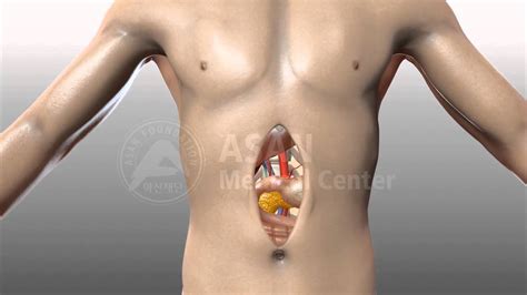 Open Abdominal Surgery Youtube