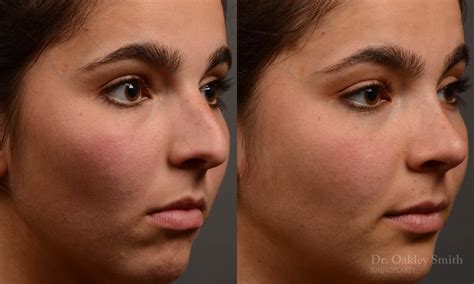 417b Rhinoplasty Dr Oakley Smith Toronto Top Surgeon Nose Job