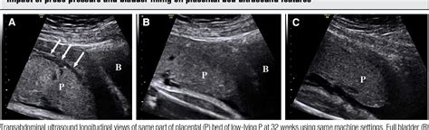 Placenta Percreta Ultrasound