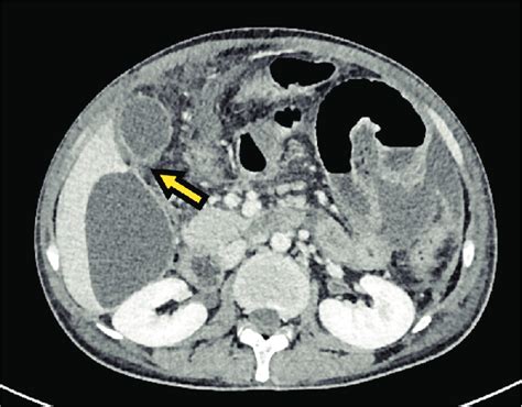 Axial Section Of Abdominal Tomography Showing Gallbladder Perforation