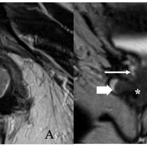 Figo Stage Ib A Year Old Female With Squamous Cell Carcinoma Of The