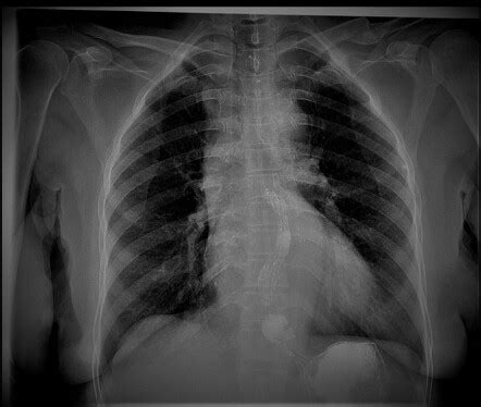 Sliding Hiatus Hernia Radiology Case Radiopaedia Org