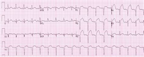 Study Medical Photos: Acute Anterior Myocardial Infarction - ECG