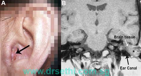 Ear Pain - Dr Dharambir S Sethi