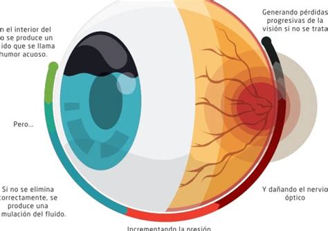 Glaucoma Una guía completa sobre qué es y cómo prevenirlo