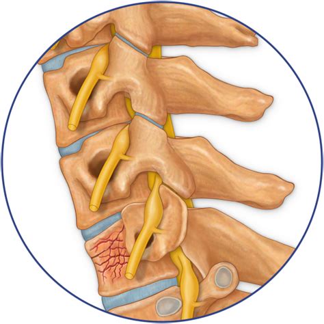 Compression Fracture C With Nerves Stock Art