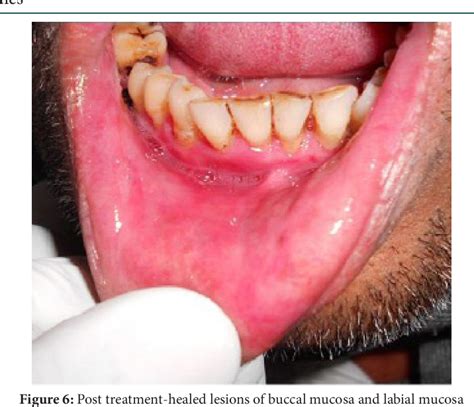 Figure From Bullous Lichen Planus A Case Report With Review Of