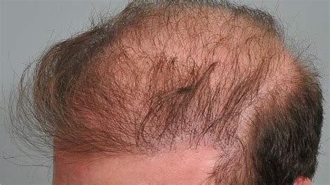 Unexpected Turn Hair Transplant Gone Wrong Mcan Health Blog