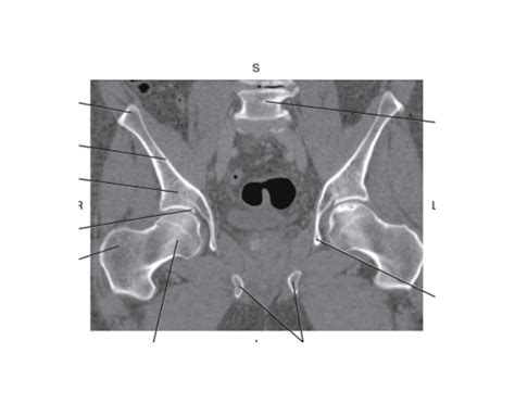 exam  pelvis  acetabulum quiz
