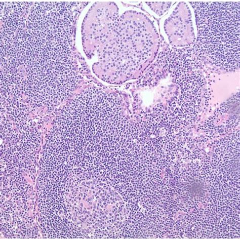 Peripancreatic Lymph Node Metastasis Of Net Download Scientific Diagram