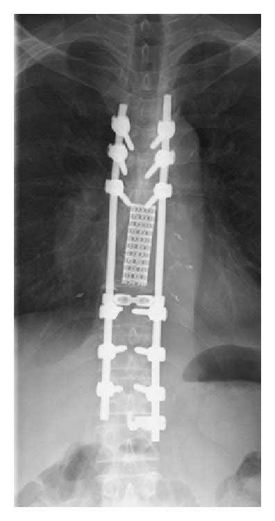 Postoperative Radiographs A Anteroposterior B Lateral Download Scientific Diagram