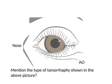 Tarsorrhaphy.pptx........................ | PPT