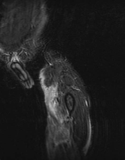 Marjolin Ulcer - Sumer's Radiology Blog