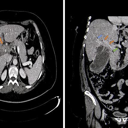 CT Scan Showed An Intrahepatic Infiltrative Mass A With Unclear