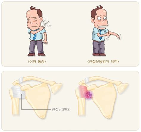 오십견 증상 및 어깨통증 치료 방법유착성관절낭염 운동 스트레칭 겨울애상