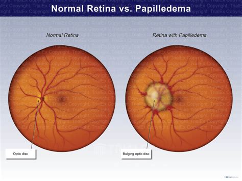 Normal Retina Vs Papilledema Trialquest Inc