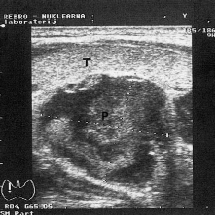 Parathyroid Gland P With Nodular Hyperplasia Thyroid Gland T