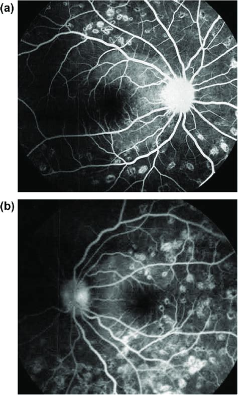 Late Phase Of Fluorescein Angiography Fa Of The Right Eye 2a And Download Scientific