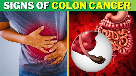 8 Warning Signs Of Colon Cancer You Shouldn T Ignore Youtube