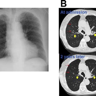 The Chest X Ray And Computed Tomography Ct Findings A Chest X Ray