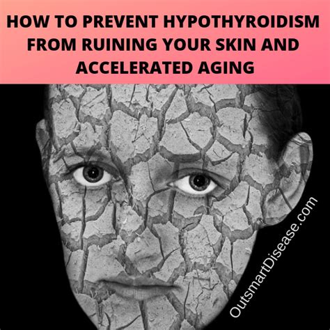 Hypothyroidism Dry Skin Treatment