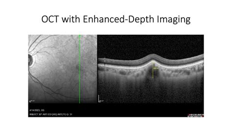 Other Retinal Issues Scott E Pautler Md Tampascott E Pautler Md Tampa Treatment Of