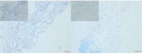 Immunohistochemical CD16 expressions in the first (FB) and second ...