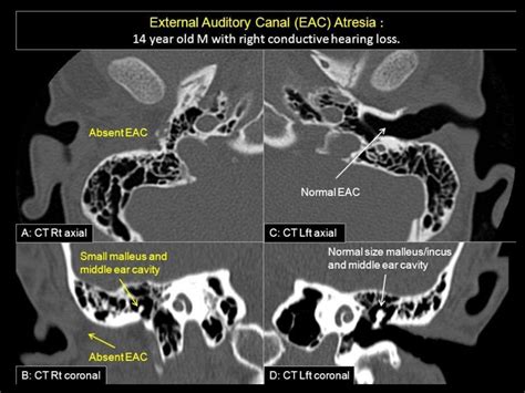 Imaging modalities of the petrous bone