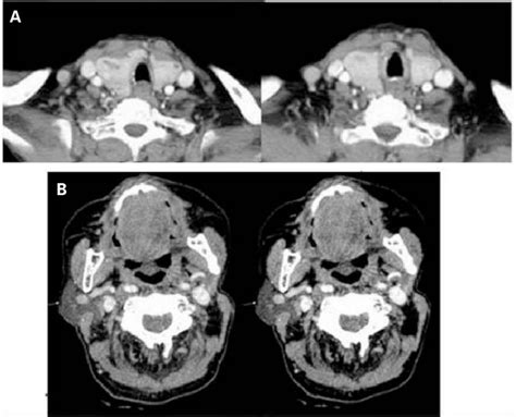 Figure 1 From Synchronous Parotid And Thyroid Gland Metastases From