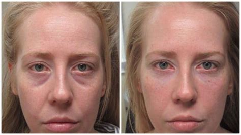 Incredible Tear Trough Under Eye Filler Results Under Eye Fillers