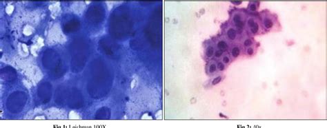 Figure From A Clinico Pathological Study On Pemphigus Vulgaris With