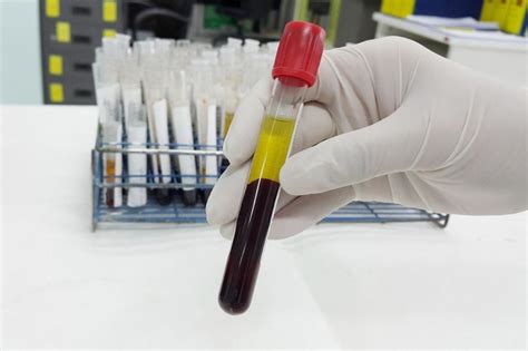 Serology Blood Test
