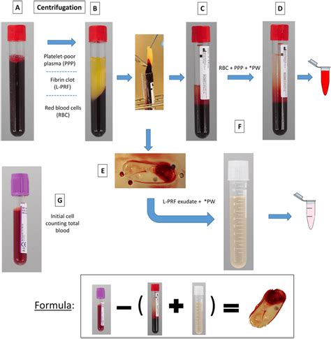 Fibrin Clot In Serum Sample