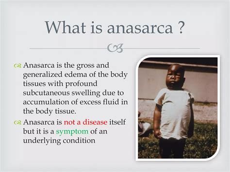 Generalized Anasarca | PPT