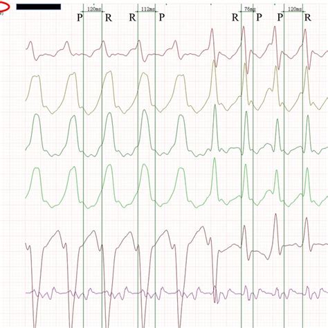 Wide Qrs Tachycardia Suddenly And Automatically Changed To Narrow Qrs