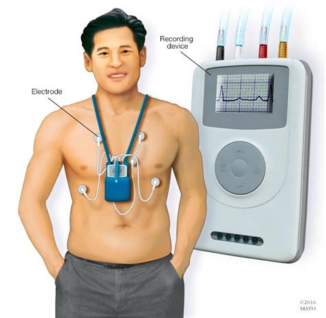 Sick Sinus Syndrome Diagnosis Treatment Mayo Clinic