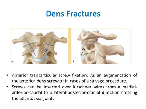 Cervical Fractures