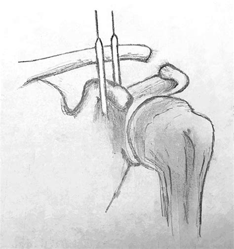 Clinical And Radiological Outcomes Of Acute Rookwood Type Iiib Acromioclavicular Joint