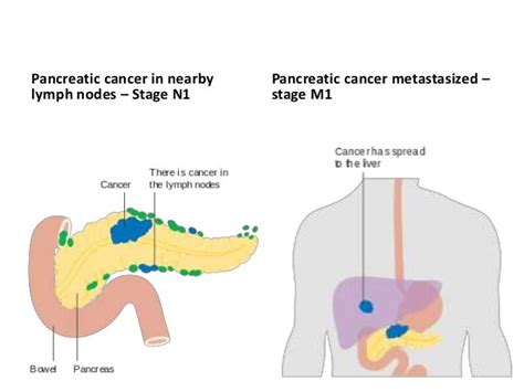 Pancreatic Carcinoma Dr Mnr