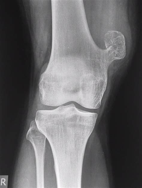 Osteochondroma Image Radiopaedia Org