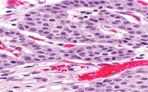 Medical Management Of Pancreatic Neuroendocrine Tumors In Patients With
