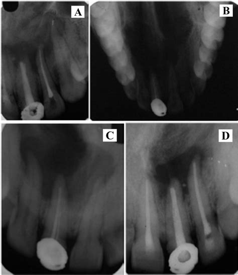 A Maxillary Occlusal View B Pre Operative Intraoral Periapical Download Scientific