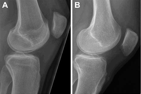 Conventional Radiographs And Magnetic Resonance Imaging For The Analysis Of Trochlear Dysplasia