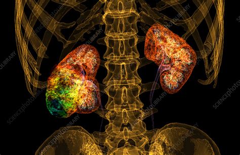 Kidney cancer, 3D CT scan - Stock Image - C049/0102 - Science Photo Library