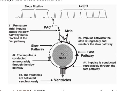 A Review of Transcatheter Ablation for the Treatment of AVNRT in ...