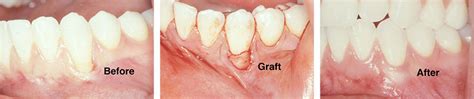 Gingival Graft Before And After