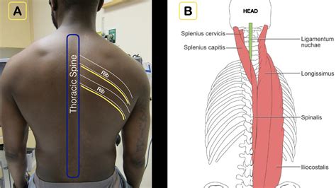 Thoracic Erector Spinae Block